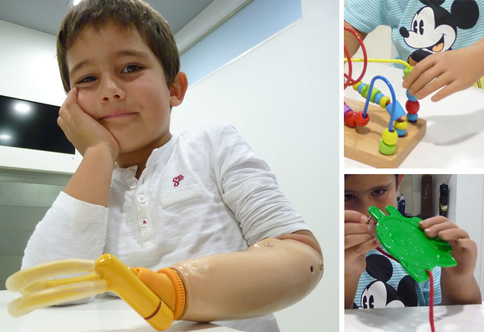 Álvaro con su prótesis mioeléctrica infantil